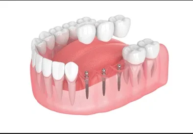 Illustration of a removable denture connecting to mini dental implants in the jaw