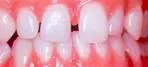 Lumineers Veneers